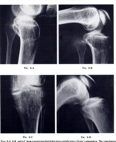 Figure 2 from Subluxation and dislocation of the proximal tibiofibular joint. | Semantic Scholar