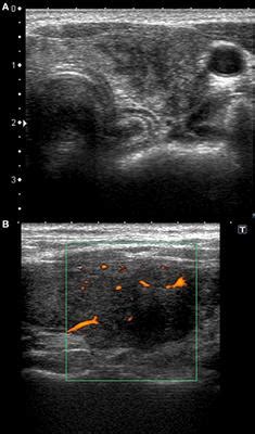 Frontiers | Sonographic Pattern of Subacute Thyroiditis Is HLA-Dependent