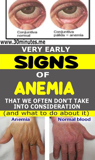 7 Signs of Anemia That You May Not Be Aware Of And How To Treat It - HEALTH and WELLNESS