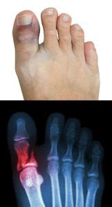 Sprained Big Toe vs. Broken Big Toe: Signs, Symptoms & Treatment Options