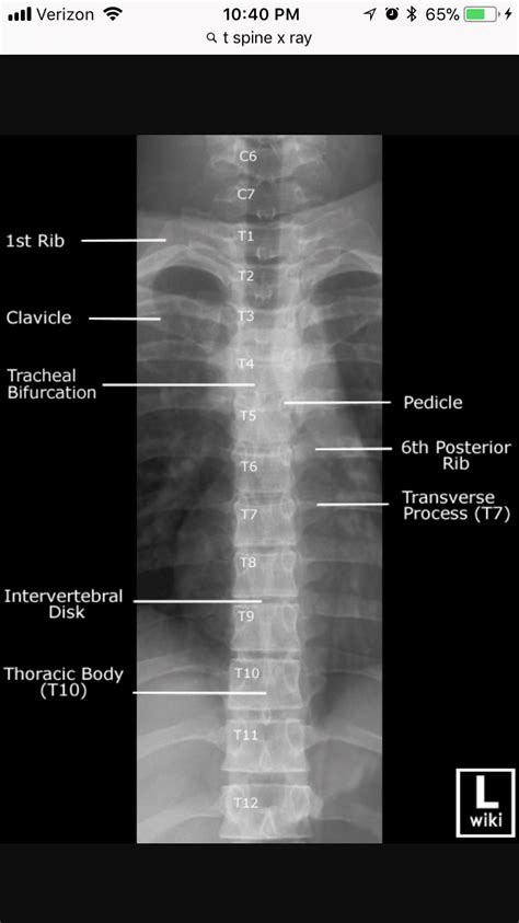 AP Thoracic Spine xray | Radiology student, Radiology imaging, Radiology