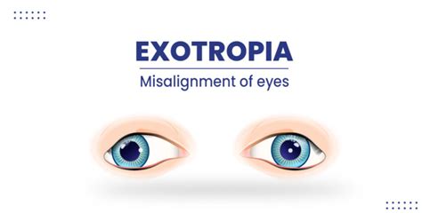 Exotropia – Types, Symptoms, Diagnosis, and Risk factors