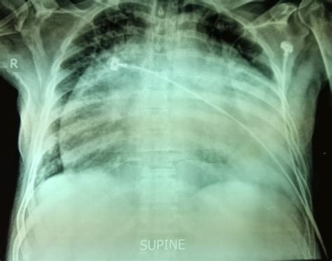 dr pankaj goel: Case of the Month- Giant Right Atrium with Rheumatic ...