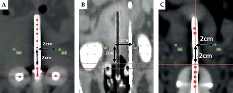 Indian Brachytherapy Society Guidelines for radiotherapeutic management of cervical cancer with ...