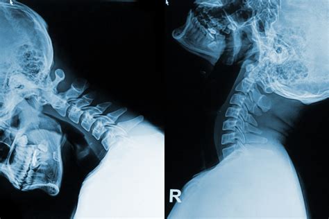 Many Accidents Can Cause Herniated Discs at C4/C5 or C5/C6 | Kevin ...