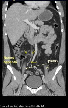 20 Appendicitis CT ý tưởng | siêu âm, y học, học tập