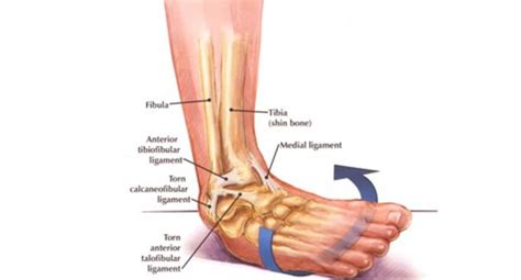 Ankle Sprains: Symptoms, Treatments & Prevention | Watsonia Podiatry