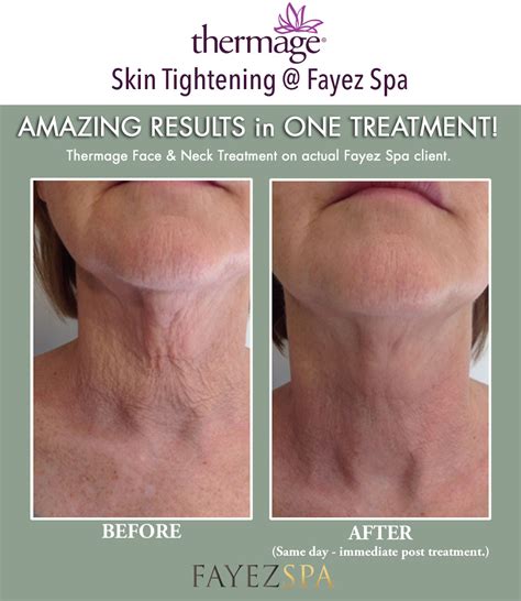 Thermage CPT Treatment London Ontario - Fayez Spa