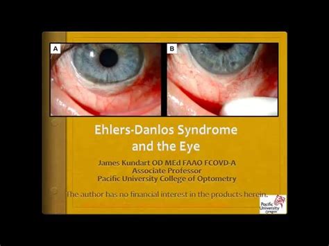 Ehlers-Danlos Syndrome and the Eye | Ehlers danlos syndrome, Ehlers ...