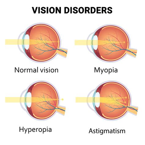 Refractive Errors - Vitreous Retina Macula Consultants of New York