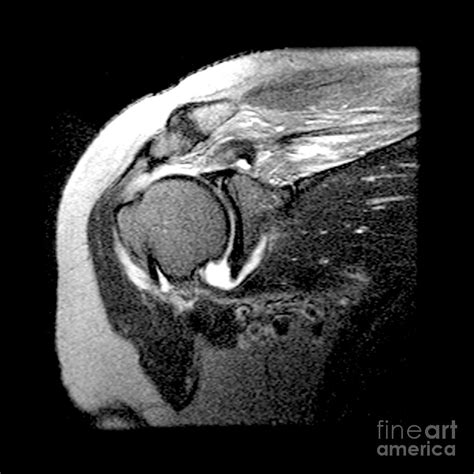 Rotator Cuff Tear Photograph by Medical Body Scans