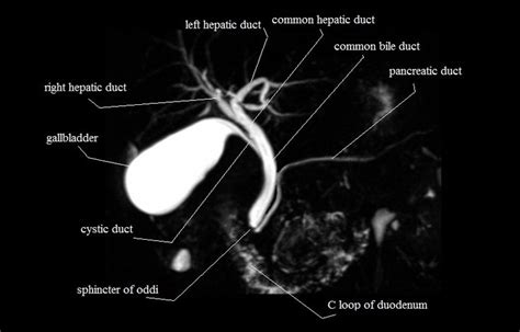 MRI MRCP Anatomy| Free MRI Coronal Cross Sectional Anatomy of the Biliary System | Radiology ...