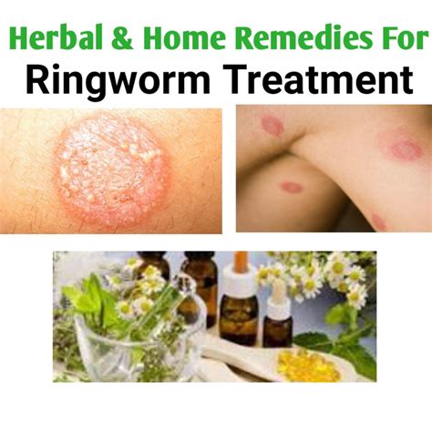 Best Medications For Ringworm Treatment - Public Health