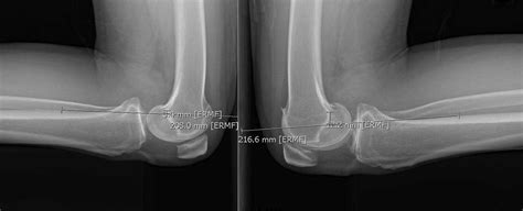 PCL Injury | Posterior Cruciate Ligament Tear | Knee Specialist | Minnesota