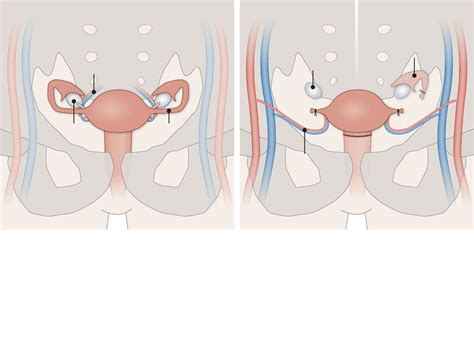 Uterus Transplants May Soon Help Some Infertile Women in the U.S ...