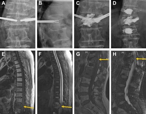 T11 Vertebrae Fracture