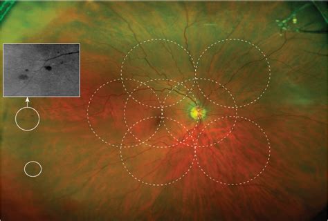 Optos Ultra-widefield Retinal Imaging System - mivision