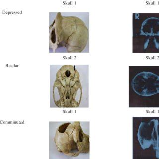 Types of skull fractures encountered | Download Table