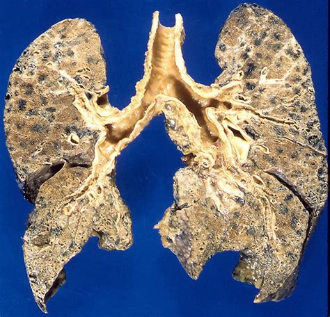 Emphysema, centrilobular - a photo on Flickriver