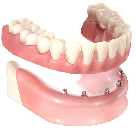 Implant Retained Dentures | HQ Dental, Leeds, UK