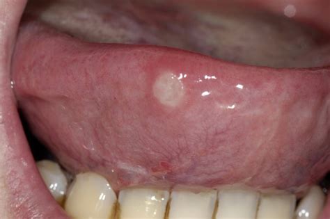 Small Ulcers On Tongue