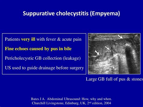 Ultrasound of acute & chronic cholecystitis