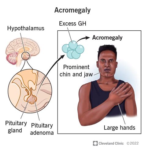 Acromegaly: What It Is, Causes, Symptoms & Treatment