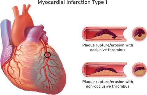 Myocardial Infarction