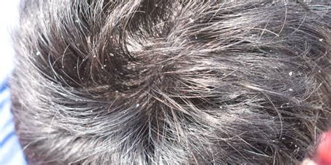 Severe Scalp Dandruff