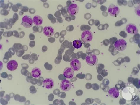 Chronic Myeloid Leukemia presentation in peripheral blood 1