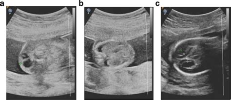 ultrasound findings of the first fetus. a increased nuchal fold with... | Download Scientific ...