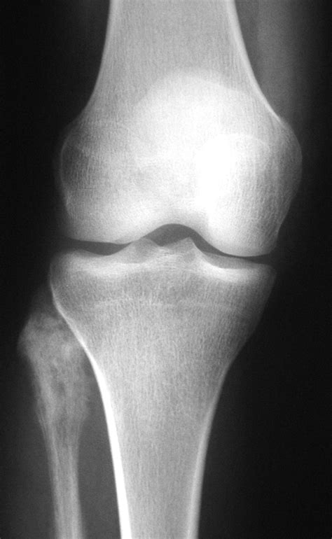 Osteosarcoma (X-Ray) - radRounds Radiology Network