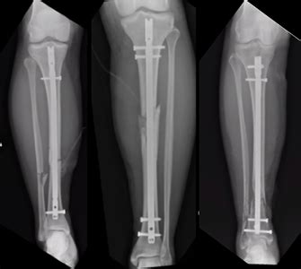 Sustancial transferencia de dinero clímax tibial rod surgery recovery time Hierbas elemento Doncella