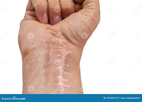 Scar with Stitches on the Wrist after Surgery. Fracture of the Bones of the Hands in Fist ...