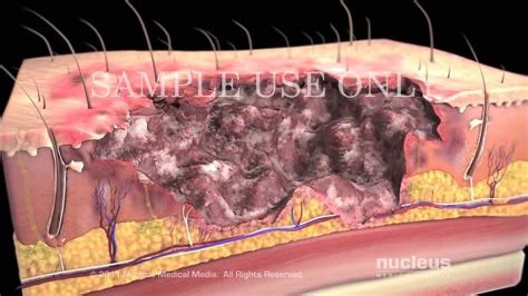 Burns: Classification and Treatment - YouTube