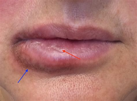 Recurrent blisters on the lip | The BMJ