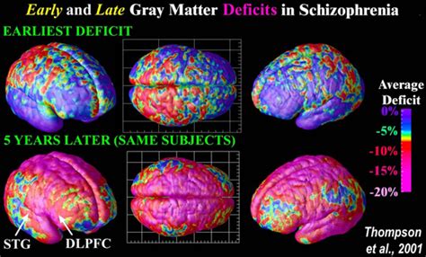 Schizophrenia.com - Schizophrenia is a Brain Disease