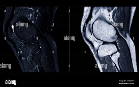 Magnetic resonance imaging or MRI of knee joint. This diagnostic ...