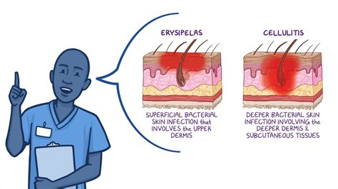 Erysipelas and cellulitis: Nursing - Osmosis Video Library