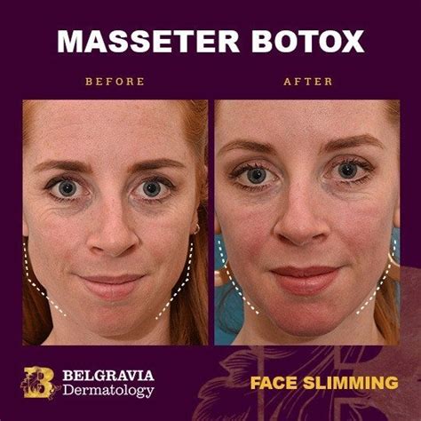 How Long Does Masseter Botox Take to Work? – the BEAUTIOUS