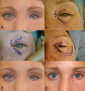 Canthal web revision (Canthoplasty, Revision Canthoplasty) - Cosmetic Eyelid Surgery in Beverly ...