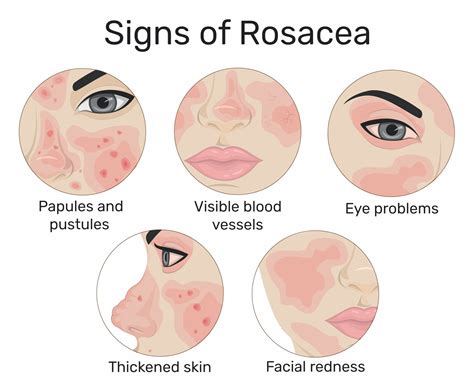 Rosacea Around The Eyes