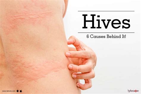 Hives Rash or Urticuria - 6 Cause Behind Skin Disorder - By Kaya Skin ...