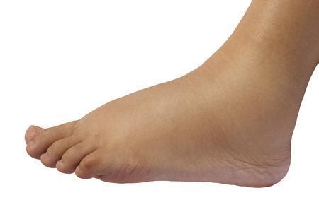 7 Reasons for Swelling in Feet and Ankles: Affiliated Foot & Ankle Care: Podiatrists