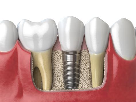 Best Dental Implant Infection Treatment? Warning