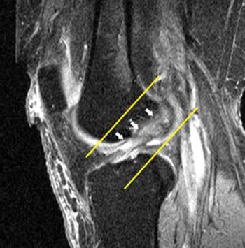 Partial ACL Tear - Radsource