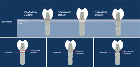 The benefits of tissue level implants restoratively - ITI Blog