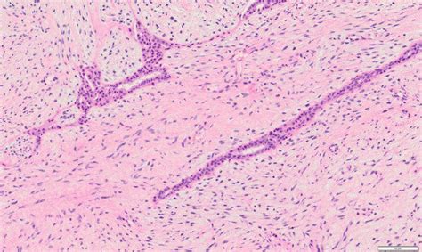 Histology of the core needle biopsy from the left breast tumor.... | Download Scientific Diagram