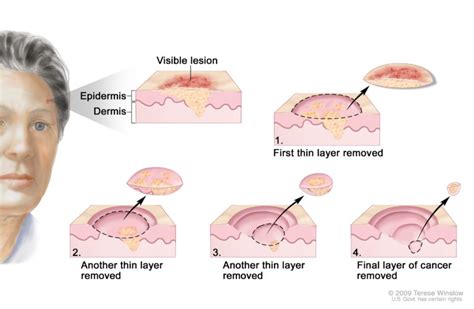 Treating Basal Cell Carcinoma: Treatment Options – Skin Cancer Education and Research Foundation