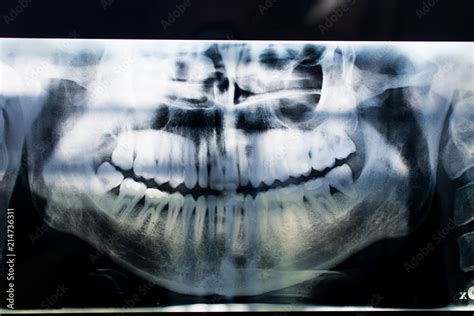 X-ray of a mouth with all visible teeth and cavity in evidence ...